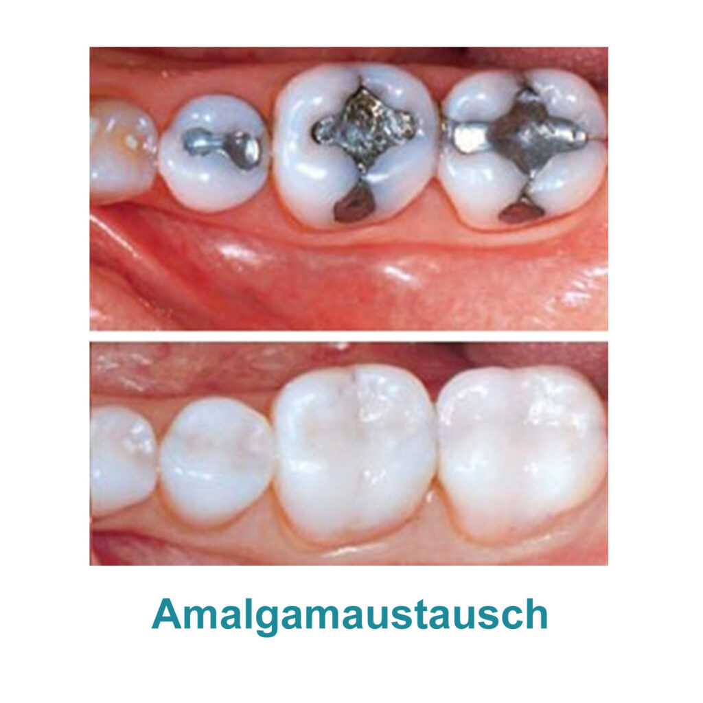 Amalgamaustausch in der Zahnarztpraxis Kräling