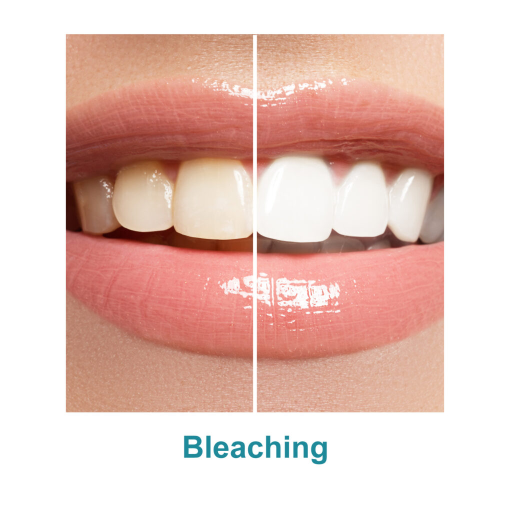 Bleaching in der Zahnarztpraxis Kräling