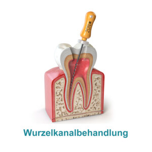 Wuzelkanalbehandlung in der Zahnarztpraxis Kräling