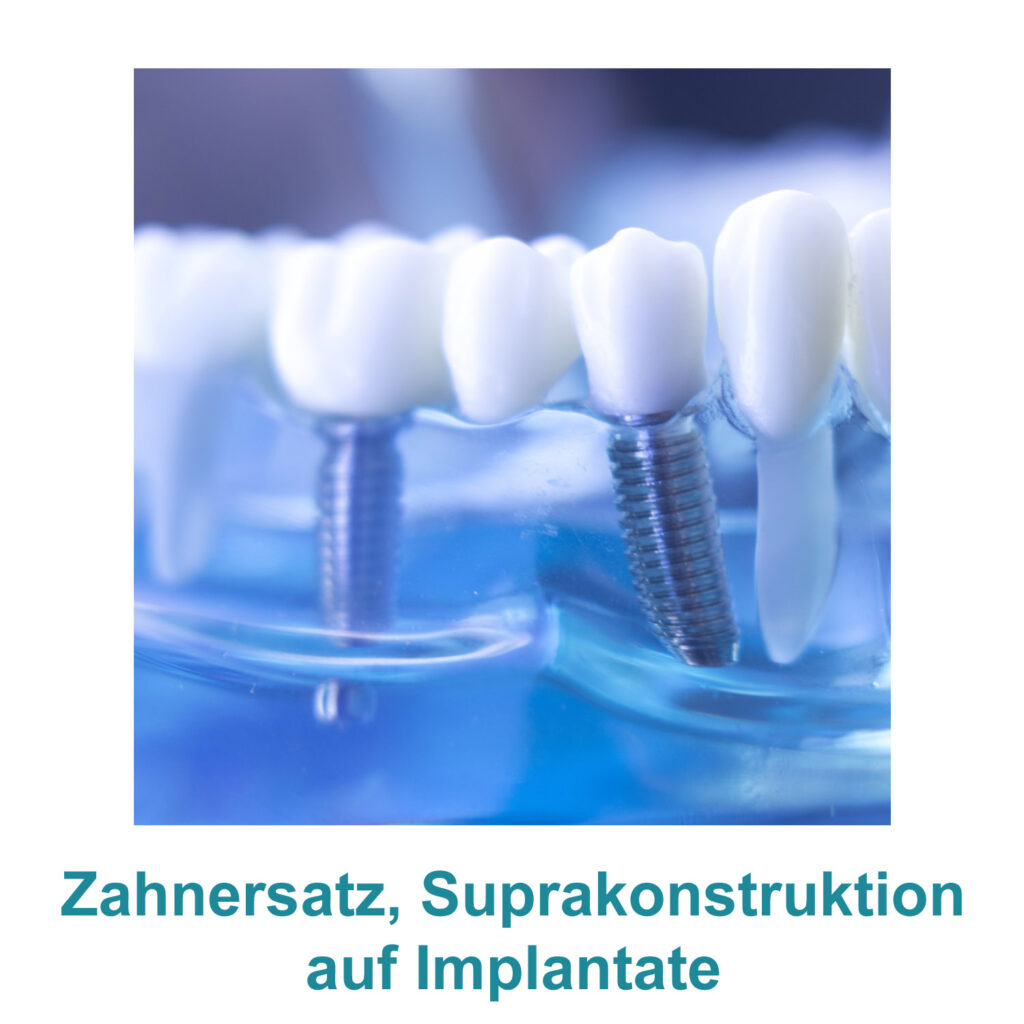 Zahnersatz, Suprakonstruktion auf Implantate - Zahnarztpraxis Kräling